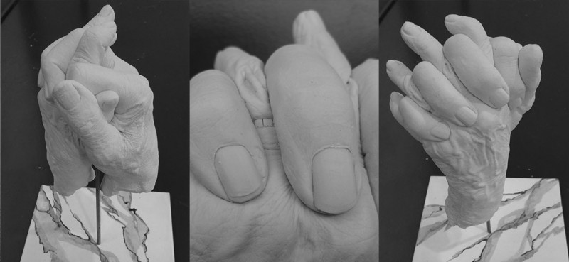 Témoignage : la vie d'après, le couple intime face au cancer